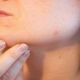 acne treatment market